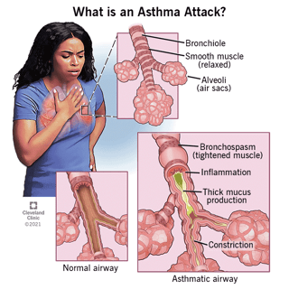 Picture of asthma