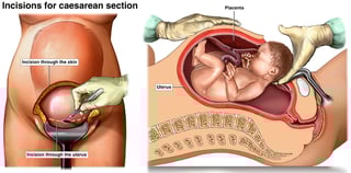 Picture of Caesarean section