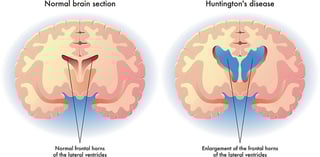 Picture of Huntington's disease