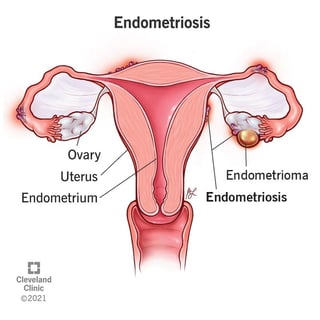 Picture of endometriosis