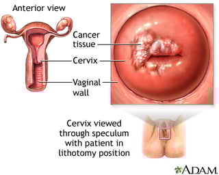 Picture of cervical cancer