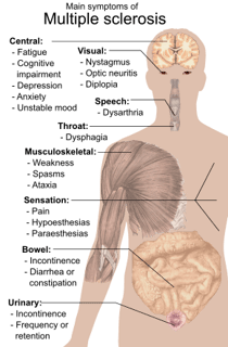 Picture of multiple sclerosis