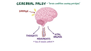 Picture of Cerebral palsy