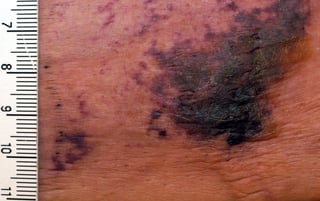 Picture of Calciphylaxis