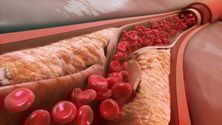 Picture of Low-density lipoprotein