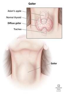 Picture of toxic diffuse goiter