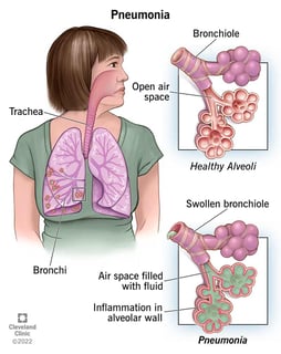 Picture of pneumonia