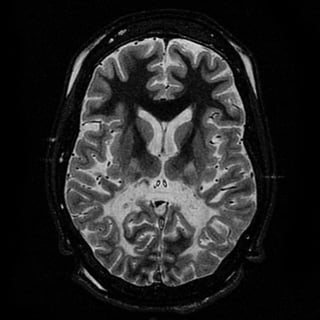 Picture of X-linked adrenoleukodystrophy