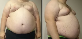 Picture of abdominal obesity
