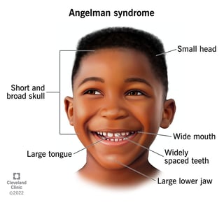 Picture of Angelman syndrome