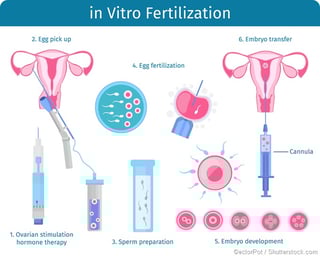 Picture of in vitro fertilization