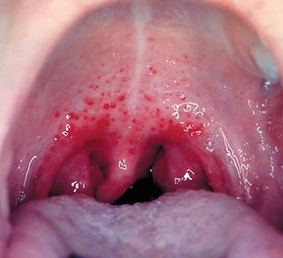 Picture of Group A streptococcal infection