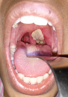 Picture of diphtheria