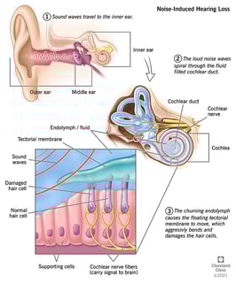 Picture of noise-induced hearing loss
