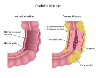 Picture of Crohn's disease