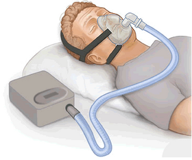 Picture of Positive airway pressure