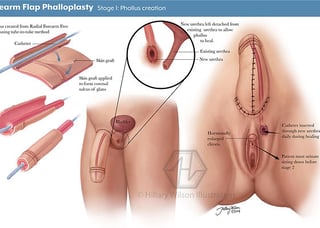 Picture of Gender-affirming surgery
