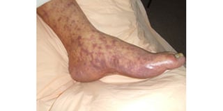 Picture of Rocky Mountain spotted fever