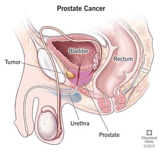 Picture of prostate cancer
