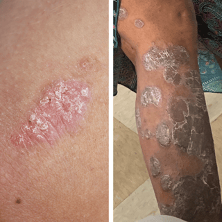 Picture of Skin rash