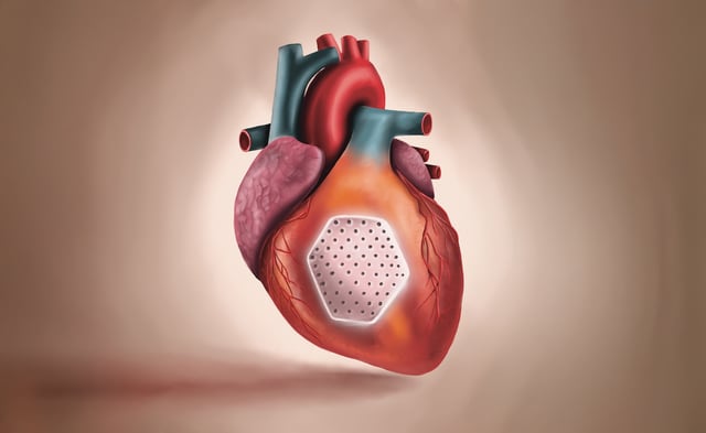 The heart patch is produced from induced pluripotent stem cells derived heart muscle cells in a collagen hydrogel. Graphic: umg/eva meyer-besting