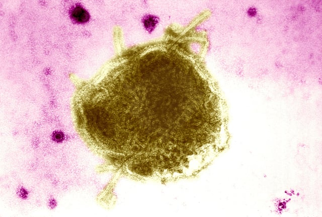 This Electron Micrograph Reveals Both A Paramyxovirus Measles Virus, And Virions Of The Polyomavirus, Simian Virus Sv40 Smaller Circles. The Envelope Of The Measles Virus Has Broken, Exposing The Nucleocapsid Filaments. Interest In Sv40 Has Increased In The Last Several Years Because The Virus Was Found In Certain Forms Of Cancer In Humans, For Instance Mesotheliomas Rare Tumors Located In The Lungs, Brain, And Bone Tumors Carbone Et Al. , 1994; Jasani Et Al. , 2001. (Photo By BSIP/UIG Via Getty Images)