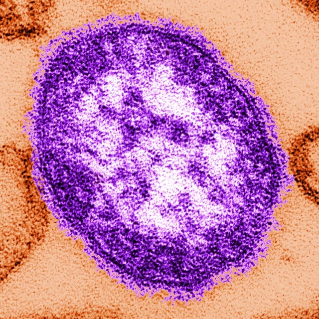 This undated image made available by the Centers for Disease Control and Prevention on Feb. 4, 2015 shows an electron microscope image of a measles virus particle. THE CANADIAN PRESS/AP, HO — Centers for Disease Control and Prevention, Cynthia Goldsmith