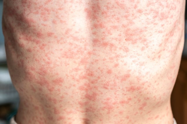 Measles, which can cause a rash like shown above, is on the rise in Texas.