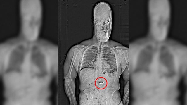 Orlando police released an x-ray image that appeared to show a foreign object in the suspect&#39;s abdomen.