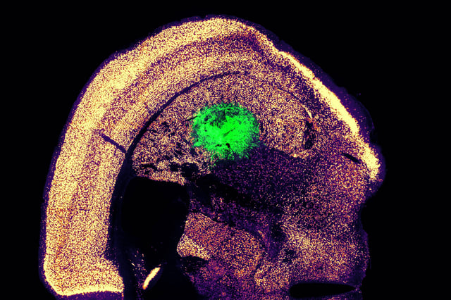 Researchers at MIT have devised a simplified process to convert a skin cell directly into a neuron. This image shows converted neurons (green) that have integrated with neurons in the brain’s striatum after implantation.