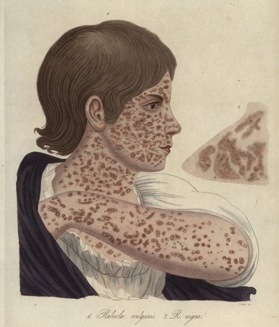 Gravure au pointillé sur cuivre représentant la rougeole et la rubéole, coloriée à la main par John Pass, tirée de l'« Encyclopédie Londinensis » de John Wilkes, édition J. Adlard, Londres, 1822.