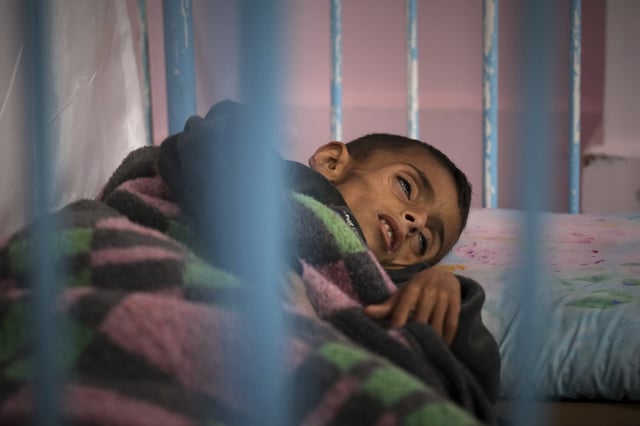 Osama al-Raqab, 5, whose mother says his cystic fibrosis has worsened since the start of the war due to the lack of meat, fish and enzyme tablets to help him digest food, is being treated at the malnutrition clinic in Nasser hospital, Khan Younis, Gaza, on Thursday, May 1, 2025. (AP Photo/Abdel Kareem Hana)