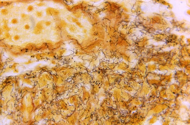 FILE - This 1966 microscope photo made available by the Centers for Disease Control and Prevention shows a tissue sample with the presence of numerous, corkscrew-shaped, darkly-stained, Treponema pallidum spirochetes, the bacterium responsible for causing syphilis. On Tuesday, Nov. 7, 2023, alarmed by yet another jump in syphilis cases in newborns, U.S. health officials are calling for stepped-up prevention measures, including encouraging millions of women of childbearing age and their partners to get tested for the sexually transmitted disease. (Skip Van Orden/CDC via AP, File)