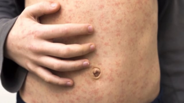 There were 365 confirmed cases of measles in Alberta as of noon on Monday, with nearly two-thirds of cases in the south health zone.