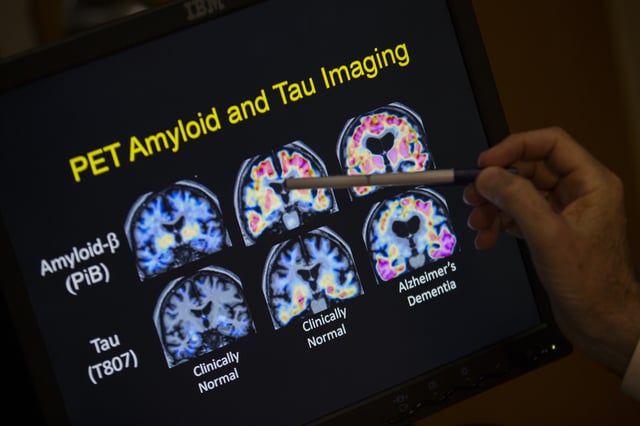 FILE - R. Scott Turner, Professor of Neurology and Director of the Memory Disorder Center at Georgetown University Hospital, points to PET scan results that are part of a study on Alzheimer's disease at Georgetown University Hospital in Washington, May 19, 2015. (AP Photo/Evan Vucci, File)