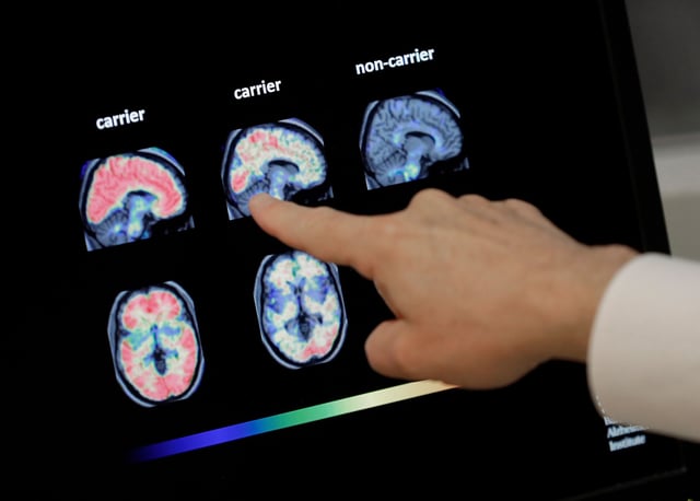 The new test may help reduce reliance on positron emission tomography or PET scans, a type of brain imaging that can be expensive.