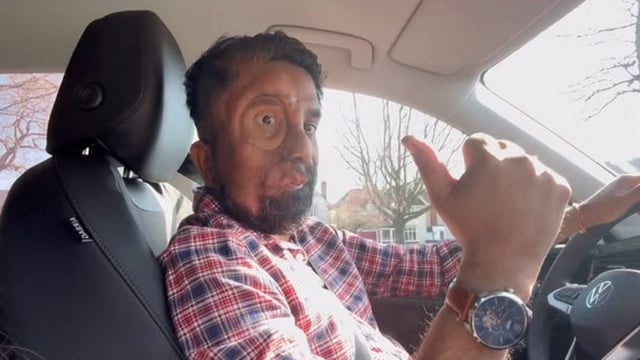 Amit Ghose is a motivational speaker who was born with Neurofibromatosis type 1, a condition that causes non-cancerous tumours.