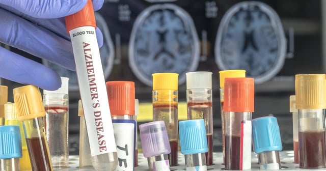 Alzheimer's diagnosis is set to become easier and less invasive
