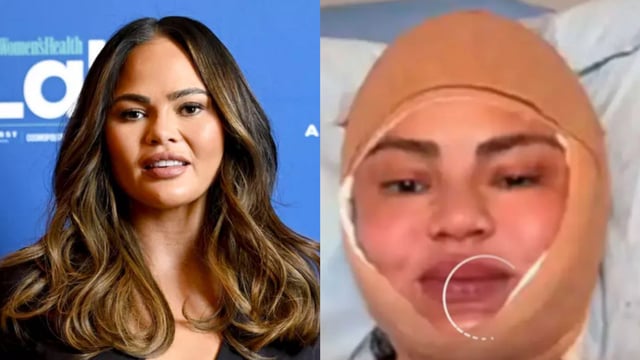 Chrissy Teigen opens up about her newest cosmetic procedure