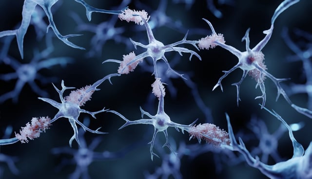 Alzheimer's protein aggregates around brain cells