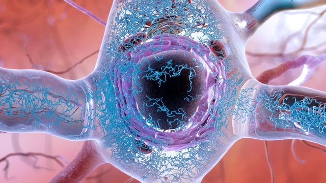 An illustration of a brain cell in a person with Alzheimer's disease, showing the accumulation and clumping of tau proteins (blue squiggles) in the cytoplasm of brain cells. Protein clumps, also known as aggregates, are thought to lead to cell death and dementia. New research suggests that such clumps may not cause brain cell death directly, but rather throw the cell's response to stress off balance so that it never gets turned off. Credit: the National Institute on Aging, National Institutes of Health