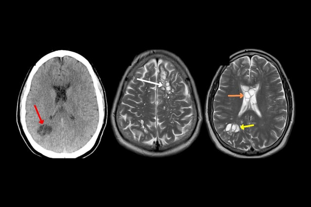 CT scans revealed numerous cystic foci, fluid-filled sacs in the brain. Cysticercosis cyst antibody tests returned positive, and the man was diagnosed with neurocysticercosis, according to the American Journal of Case Reports study.