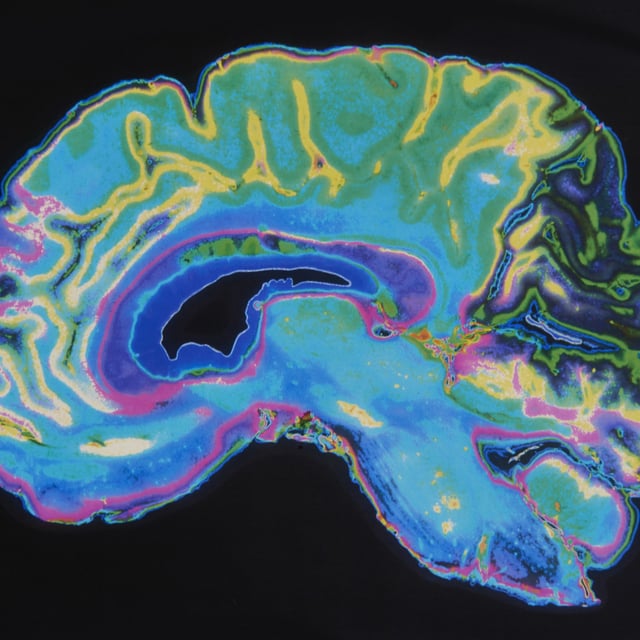 A stock photo shows a brain scan from an MRI. A new study found that neurological diseases are increasing worldwide.