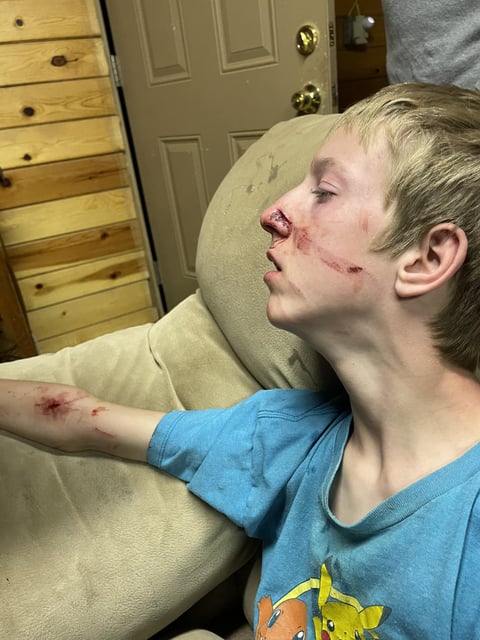 Brigham Hawkins after the bear attack.