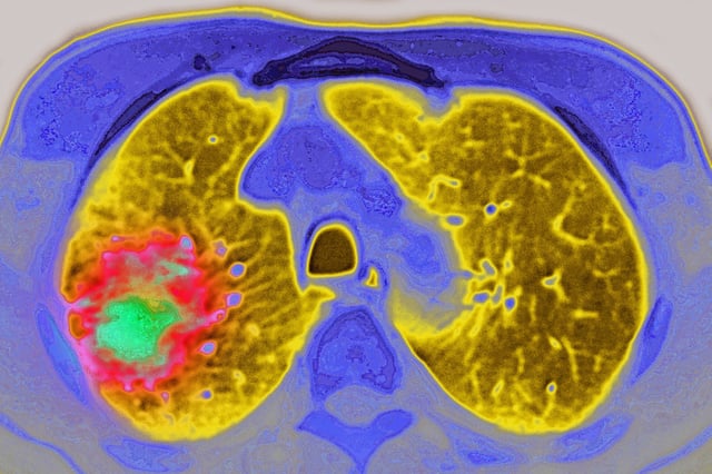 Lung cancer seen on an axial plane chest MRI scan.