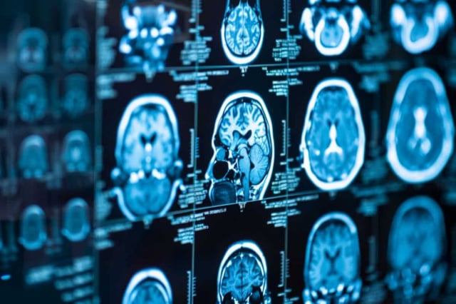 Previous large clinical trials have failed to show that this type of immunotherapy can prolong survival in glioblastoma patients. Credit: Neuroscience News