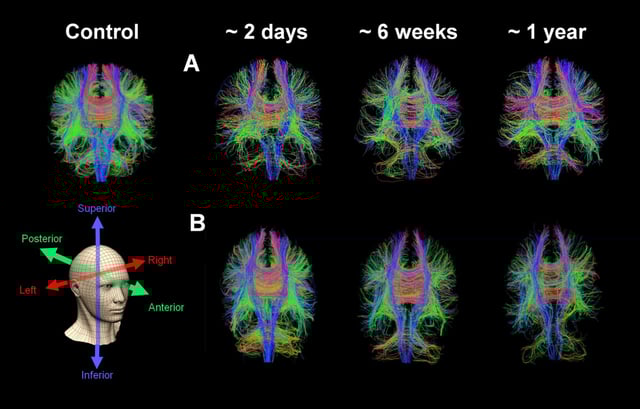 Whole brain diffusion tensor tractography in an age-matched control subject and two patients with serial images at approximately two days, six weeks, and one year following severe traumatic brain injury. Credit: Virginia Newcombe/University of Cambridge