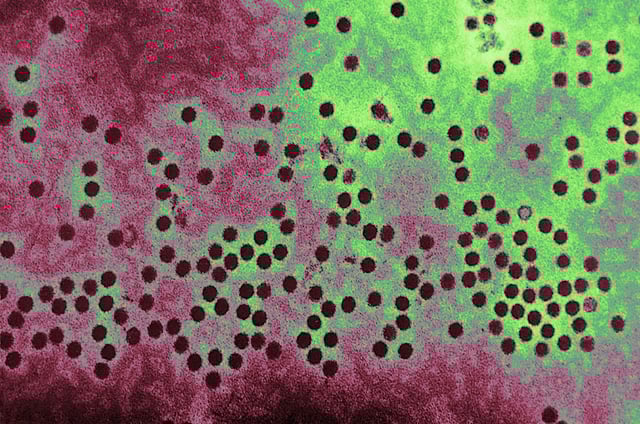 This Electron Micrograph Depicts A Number Of Parvovirus H 1 Virions Of The Parvoviridae Family Of Dna Viruses. The Parvoviridae Family Of Viruses Also Contains The Parvovirus B19 Virion, Which Is Responsible For Causing Erythema Infectiosum, Or "Fifth Disease". (Photo By BSIP/UIG Via Getty Images)