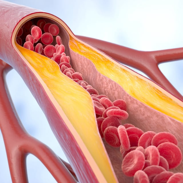Atherosclerosis disease: cholesterol in the blood vessels. When cholesterol accumulates in the blood vessels, this can harden into a plaque that increases the risk of heart-related health events, such as heart attack and stroke.